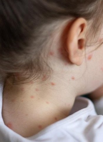 Lonjakan Kasus Campak di AS: Tantangan Vaksinasi dan Penyebaran di Lima Negara Bagian